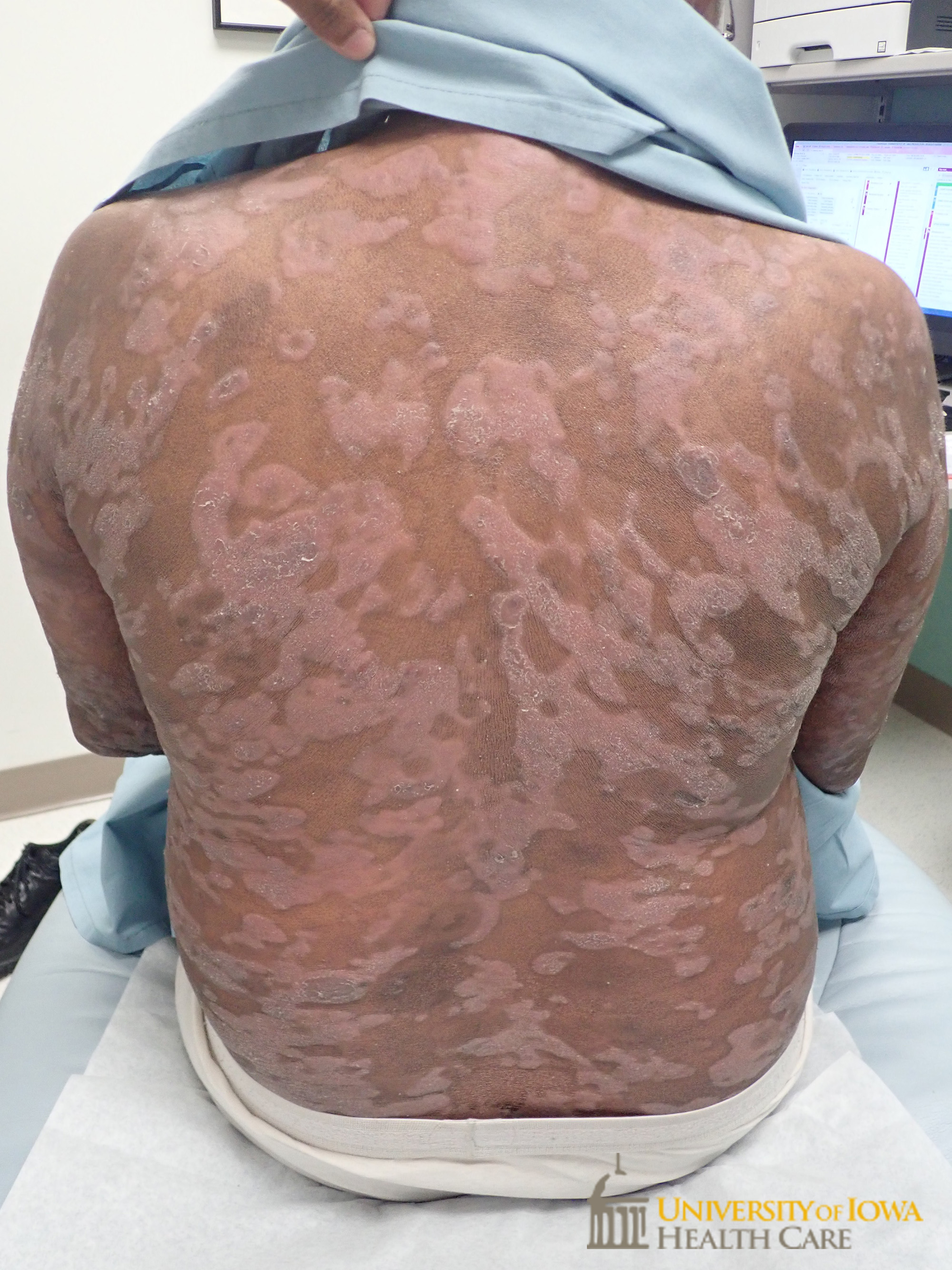 Diffuse pink to gray thick scaly plaques on the trunk. (click images for higher resolution).